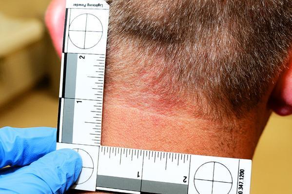 Darren Wilson’s Injuries After He Killed Michael Brown, Jr.