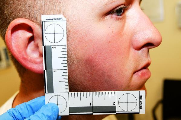 Darren Wilson’s Injuries After He Killed Michael Brown, Jr.