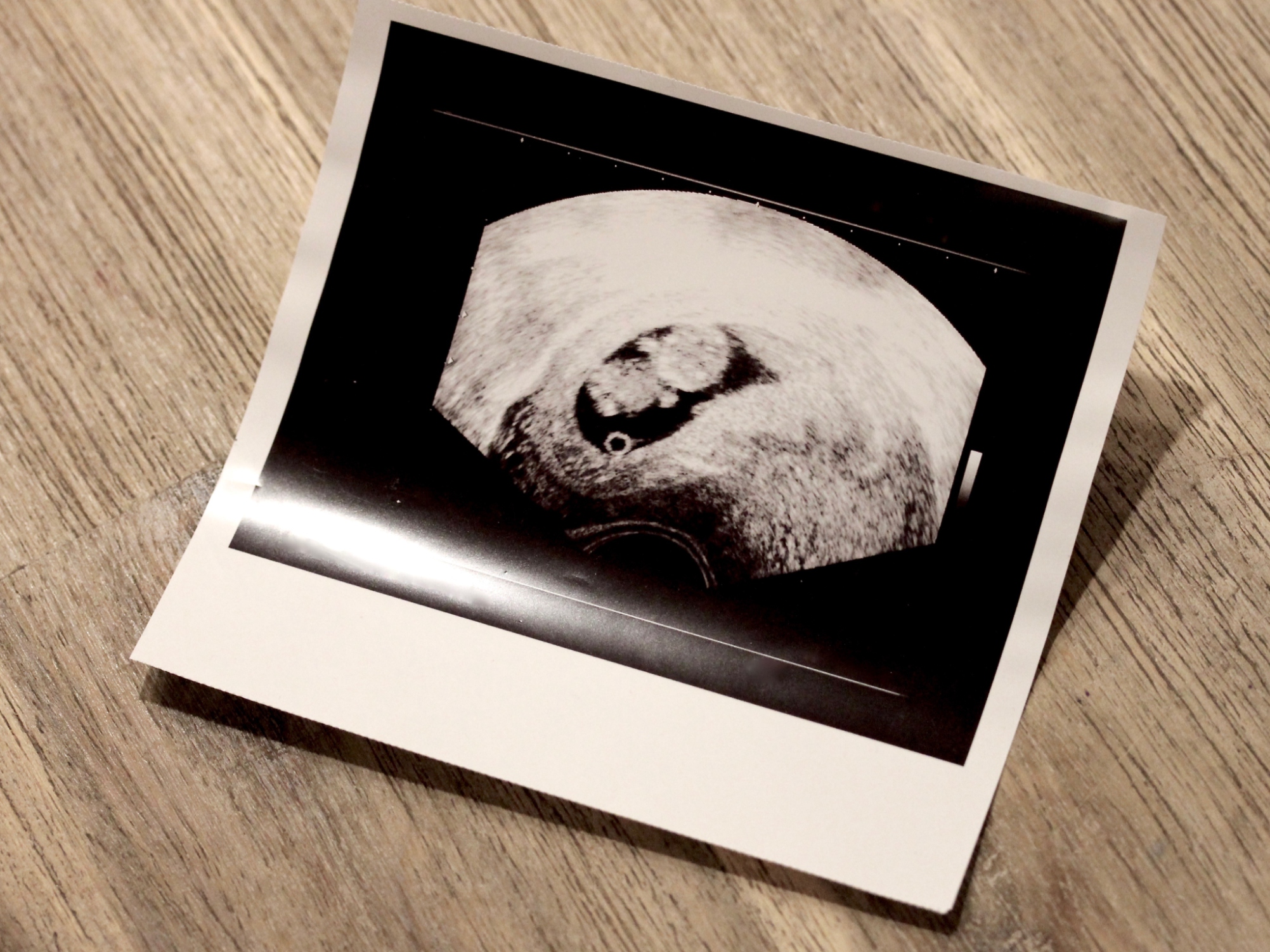 Ultrasound Photo Of A Human Fetus On Table