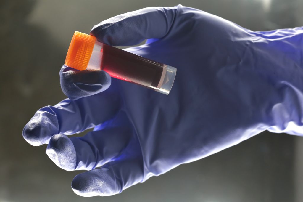 Medical Lab technician hold sample blood for testing