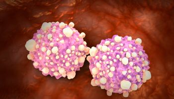 Microscipic view of pancreatic cancer cells.