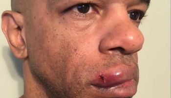 Luther Hall, St. Louis detective beaten by 3 white St. Louis cops