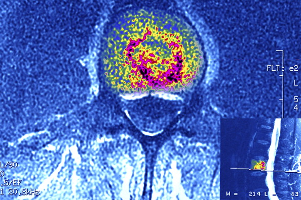 Multiple Myeloma, Bone Marrow