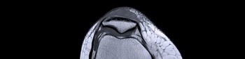 Magnetic resonance imaging or MRI of knee joint c for detect tear or sprain of the anterior cruciate ligament (ACL)