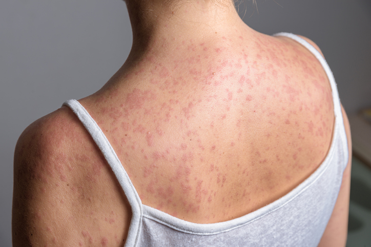 A woman with a red, spotty rash caused by measles.