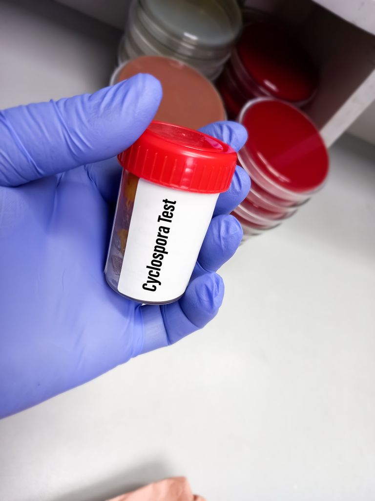 Technician holding a specimen container with stool sample for cyclospora test, to diagnosis of cyclosporiasis by examining under a microscope and finding oocysts.